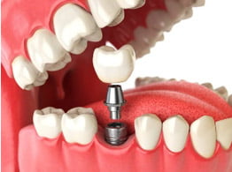 Dental Implants | Sunshine Dental
