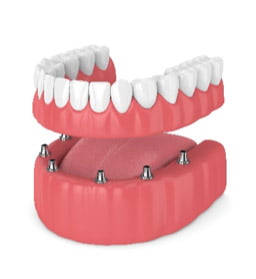 Dental Implants | Sunshine Dental